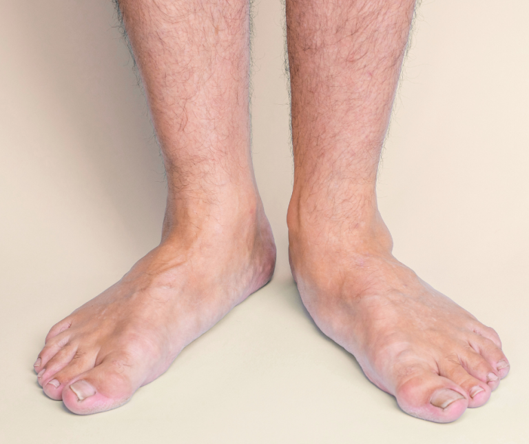 Are Flat Feet a Problem? That Depends…