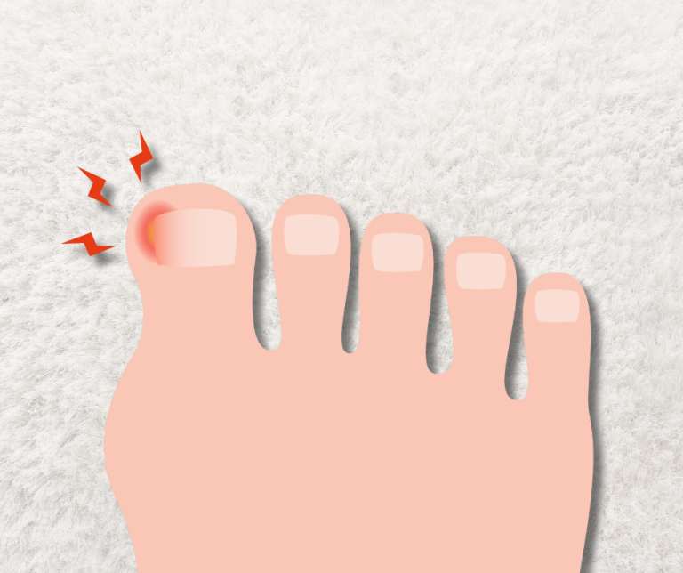 cartoon foot with ingrown toenail